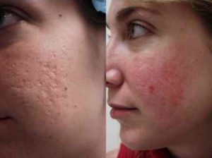 Get Cystic Acne Laser Treatment