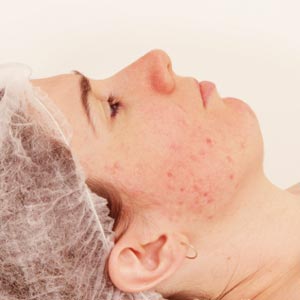 How to Get Rid of Acne - Best Solutions for Your Needs!