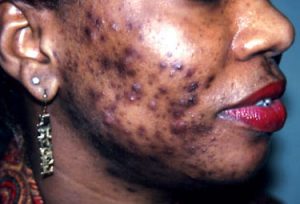 bacteria that causes acne #10